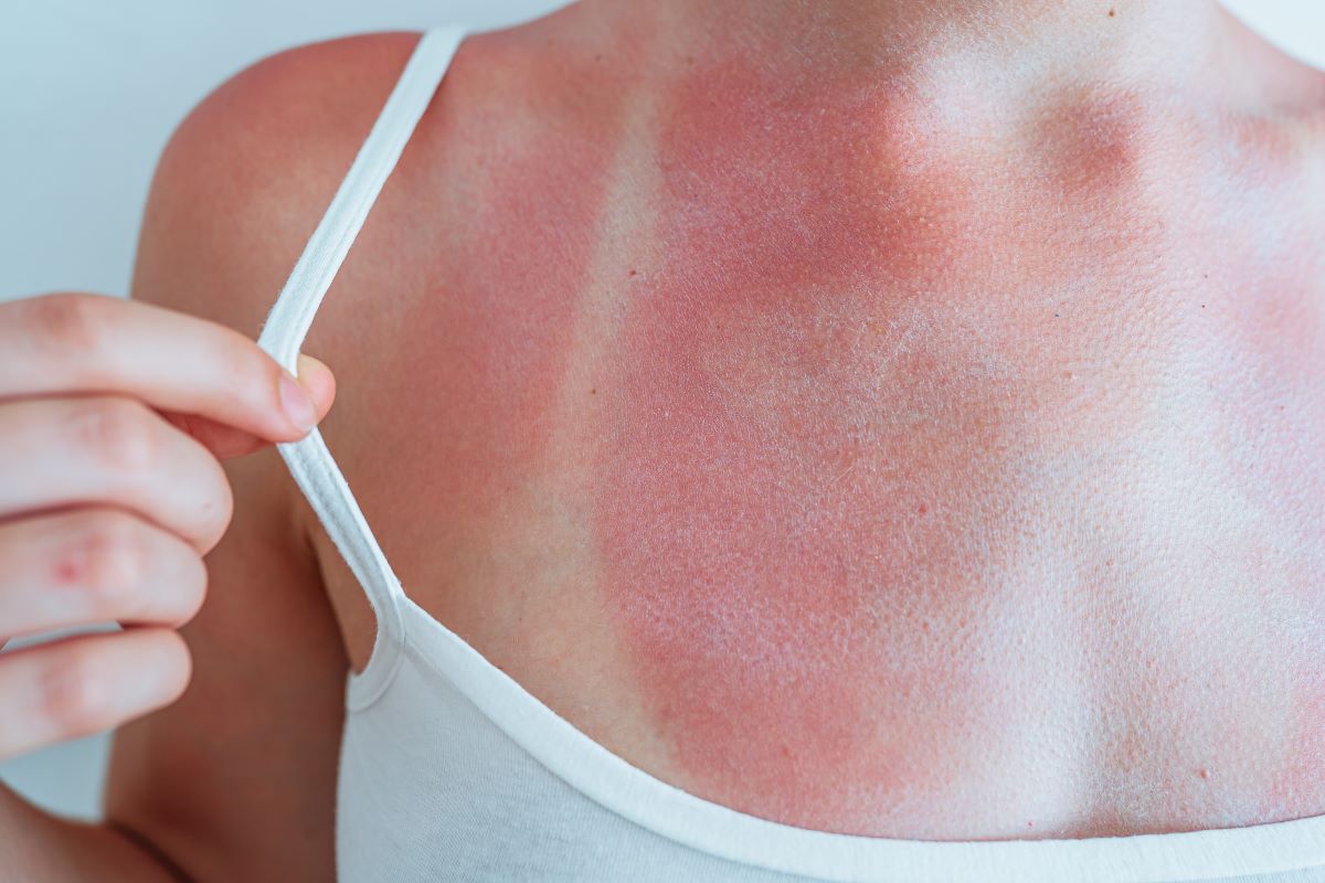 Sonnenbrand in Ammerland vermeiden und richtig behandeln – E